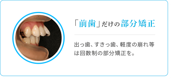 「前歯」だけの部分矯正